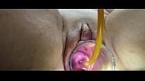Cervix Catheter sex
