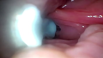 Endoscopia sex
